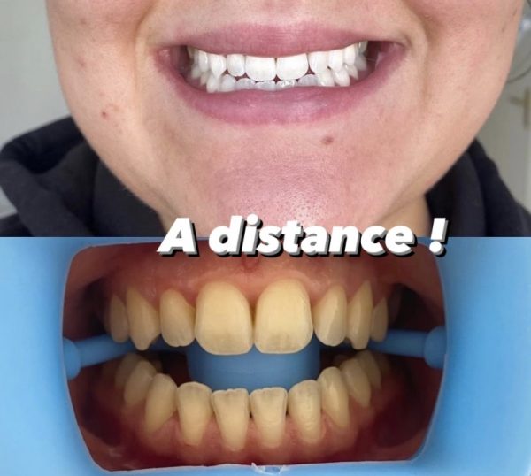 Formation blanchiment dentaire  (à distance) – Image 3